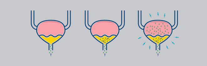 Không chỉ gây ra sỏi thận, nhịn tiểu quá lâu còn có thể gây vỡ bàng quang, nhiễm trùng đường tiết niệu - Ảnh 3.