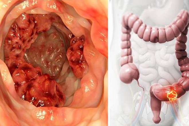 Chàng trai 17 tuổi phát hiện mình bị ung thư trực tràng thông qua những triệu chứng chẳng ai ngờ tới - Ảnh 3.