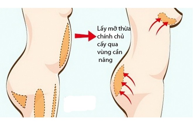 Có tới 3 kiểu tiêm thẩm mỹ đang thịnh hành nhất hiện nay nhưng không phải ai cũng nắm rõ ưu, nhược điểm từng kiểu - Ảnh 5.