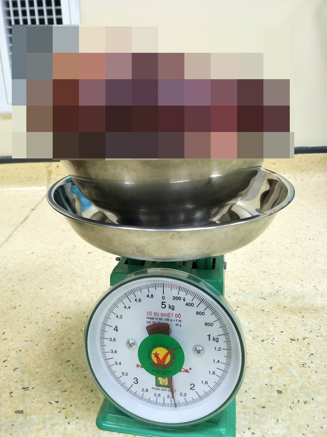 Kinh hoàng bệnh nhân 24 tuổi có khối u 2,3kg: Bác sĩ cảnh báo những triệu chứng cần đi kiểm tra ngay - Ảnh 1.