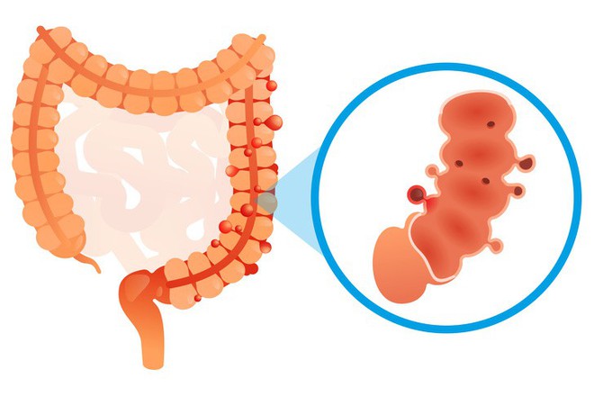 Tình trạng chướng bụng, đầy hơi có thể ngầm cảnh báo 6 vấn đề sức khỏe mà bạn không ngờ đến - Ảnh 4.