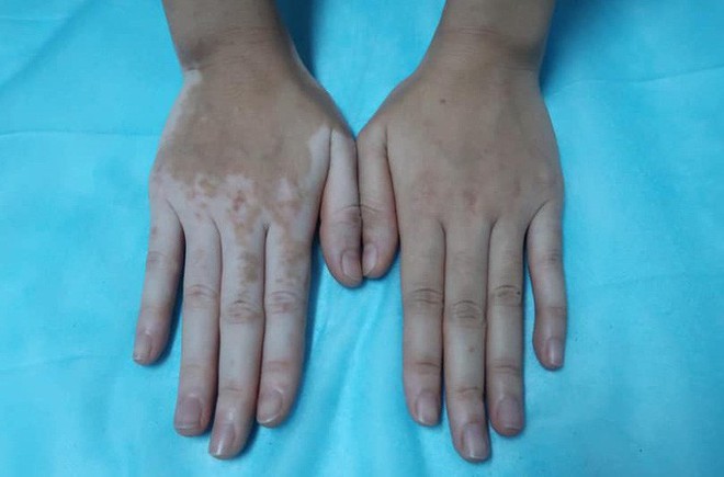  C&ocirc; g&aacute;i bỗng đổi m&agrave;u da tay, ch&acirc;n sau ng&acirc;m l&aacute; trầu kh&ocirc;ng  - Ảnh 1.