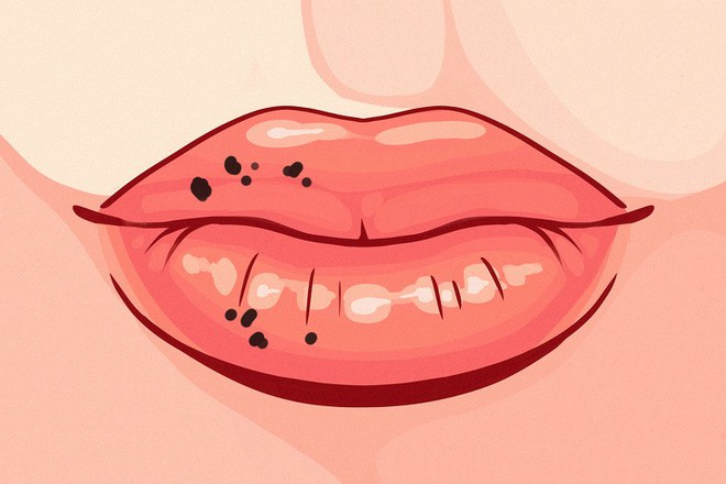 8 điều mà đôi môi đang ngầm cảnh báo sức khỏe của bạn không ổn chút nào - Ảnh 8.