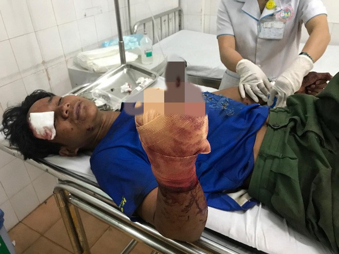 Đ&aacute;nh c&aacute; m&ugrave;ng 2 Tết, thanh ni&ecirc;n bị m&igrave;n nổ cụt b&agrave;n tay  - Ảnh 1.