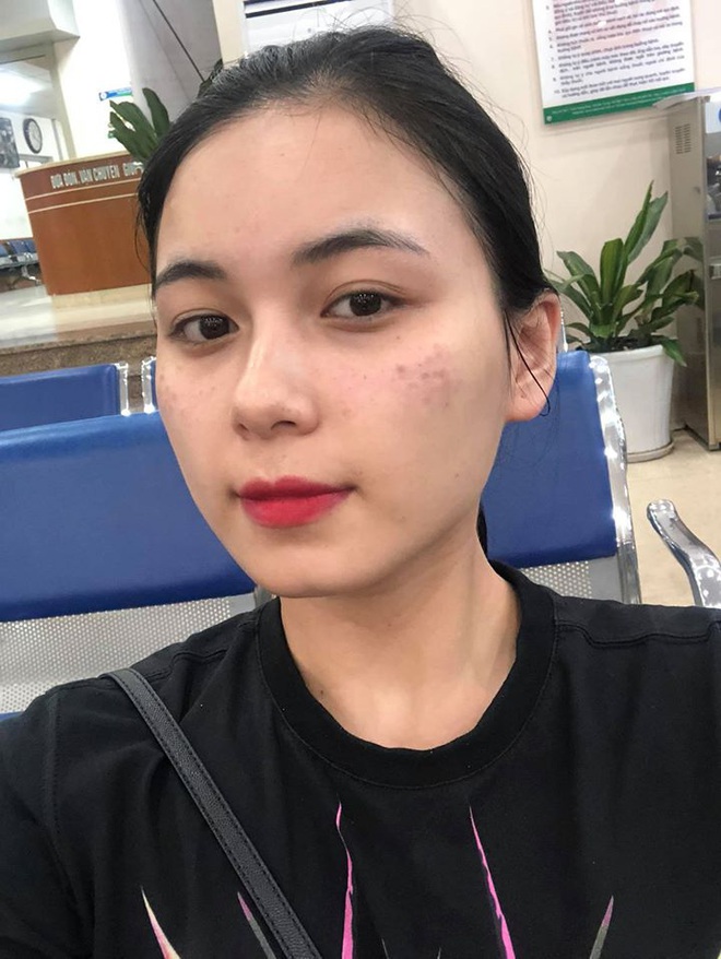 Review tường tận h&agrave;nh tr&igrave;nh trị n&aacute;m Hori bằng laser: Tưởng kh&ocirc;ng xi nh&ecirc; m&agrave; hiệu quả bất ngờ - Ảnh 1.