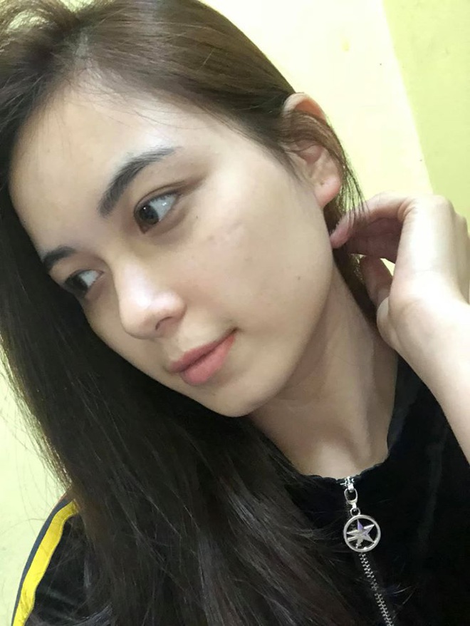 Review tường tận h&agrave;nh tr&igrave;nh trị n&aacute;m Hori bằng laser: Tưởng kh&ocirc;ng xi nh&ecirc; m&agrave; hiệu quả bất ngờ - Ảnh 11.