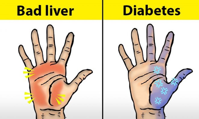 Người có chức năng gan ổn định sẽ không có 4 điểm lạ trên đôi tay, cùng xem bạn có điểm nào hay không - Ảnh 1.