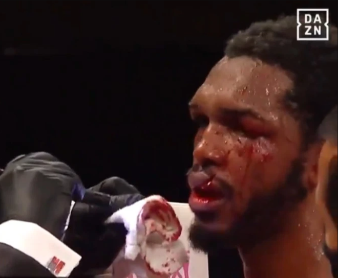 Đang thi đấu tay đấm bỗng bị trọng t&agrave;i dắt ra gặp b&aacute;c sĩ, kiểm tra th&igrave; ph&aacute;t hiện ra m&ocirc;i bị r&aacute;ch đ&ocirc;i đến kinh ho&agrave;ng - Ảnh 2.