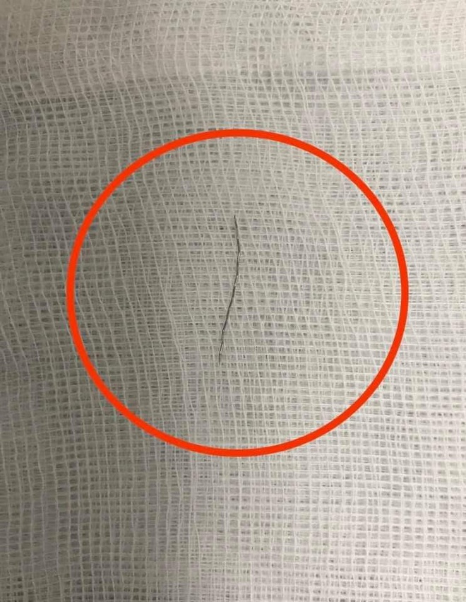 Phẫu thuật lấy mảnh th&eacute;p d&agrave;i 2cm cắm v&agrave;o th&agrave;nh họng b&eacute; 13 th&aacute;ng tuổi - Ảnh 1.