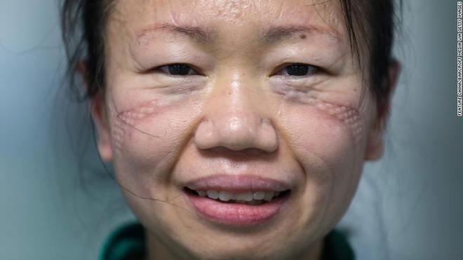 Xót thương những khuôn mặt bầm tím và đầy vết hằn của các y bác sĩ đang căng mình ra chống dịch Covid-19 trên toàn thế giới - Ảnh 5.