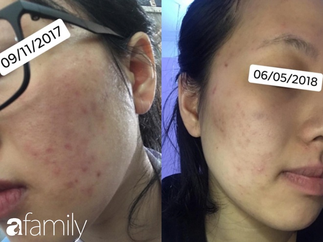 Bị ch&agrave;m v&agrave; đ&aacute;nh liều d&ugrave;ng Tretinoin, c&ocirc; n&agrave;ng n&agrave;y đ&atilde; r&uacute;t ra được v&agrave;i kinh nghiệm gi&uacute;p da căng b&oacute;ng cho c&aacute;c chị em - Ảnh 1.