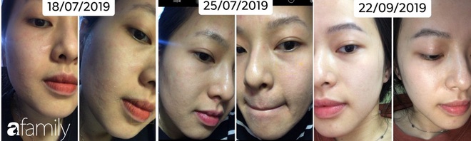 Bị ch&agrave;m v&agrave; đ&aacute;nh liều d&ugrave;ng Tretinoin, c&ocirc; n&agrave;ng n&agrave;y đ&atilde; r&uacute;t ra được v&agrave;i kinh nghiệm gi&uacute;p da căng b&oacute;ng cho c&aacute;c chị em - Ảnh 2.