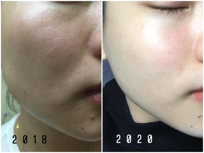 Năm 22 tuổi mới bắt đầu tập t&agrave;nh dưỡng da, t&ocirc;i đ&atilde; mất tới 4 năm để t&igrave;m được c&aacute;c sản phẩm ruột cho l&agrave;n da si&ecirc;u kh&ocirc; - Ảnh 1.