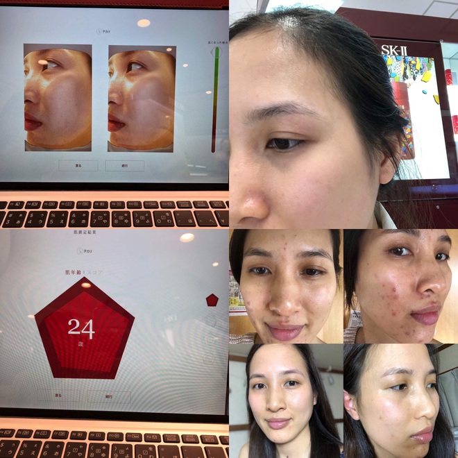 Ròng rã làm chuột bạch suốt mấy năm để trị mụn, cô nàng 33 tuổi cuối cùng đã sở hữu làn da căng đét, láng mịn như tuổi 24 - Ảnh 7.