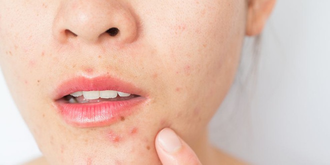 2 tuần ở nh&agrave; kh&ocirc;ng c&oacute; sản phẩm trị mụn, khi đ&oacute; nước muối sinh l&yacute; v&agrave; 3 bước l&agrave;m sạch c&oacute; thể chữa l&agrave;nh mọi hư tổn tr&ecirc;n da - Ảnh 1.