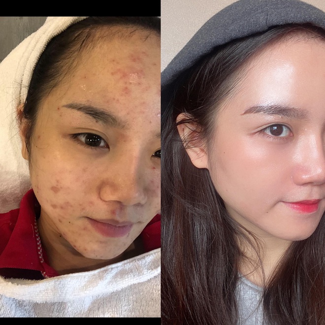 Trải qua thời kỳ da xấu thậm tệ, cô nàng này đã có cuộc cải tổ skincare với cách bôi kem chống nắng chẳng giống ai - Ảnh 3.