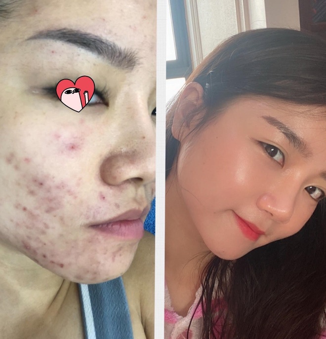 Trải qua thời kỳ da xấu thậm tệ, cô nàng này đã có cuộc cải tổ skincare với cách bôi kem chống nắng chẳng giống ai - Ảnh 4.