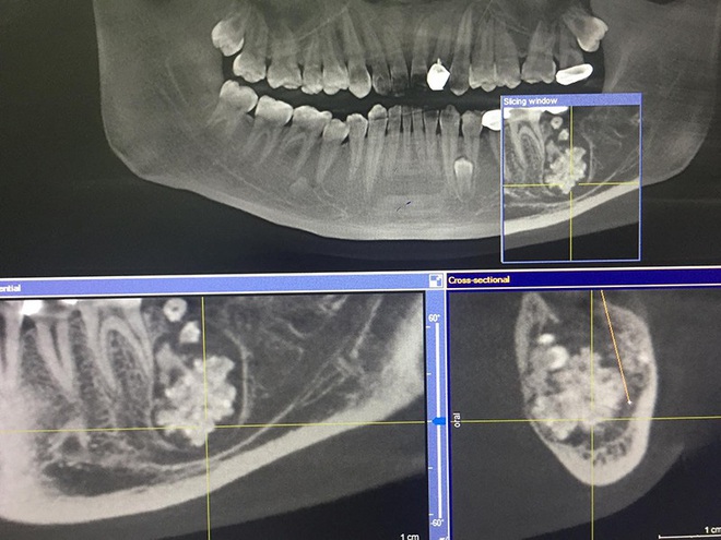 Nam thanh niên ở Hà Nội có khối u lạ chứa nhiều răng nhỏ trong miệng - Ảnh 1.