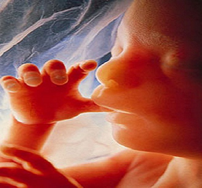 15 năm sau khi phá thai, bà mẹ choáng váng khi phát hiện con vẫn còn trong bụng và hiện tượng bào thai hóa đá hiếm gặp - Ảnh 3.