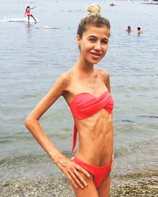 C&ocirc; g&aacute;i da bọc xương nặng vỏn vẹn 17kg từng bị v&iacute; như x&aacute;c chết trong phim kinh dị g&acirc;y x&ocirc;n xao khắp thế giới giờ ra sao? - Ảnh 3.