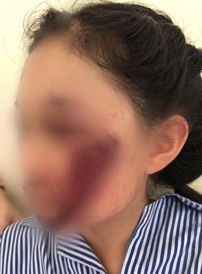 &Aacute;o chống nắng cuốn v&agrave;o b&aacute;nh xe khiến nữ sinh tổn thương mặt nghi&ecirc;m trọng - Ảnh 1.