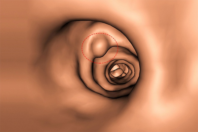 Polyp là gì? 4 bộ phận trong cơ thể nếu có polyp thì nguy cơ mắc bệnh ung thư là rất cao - Ảnh 3.