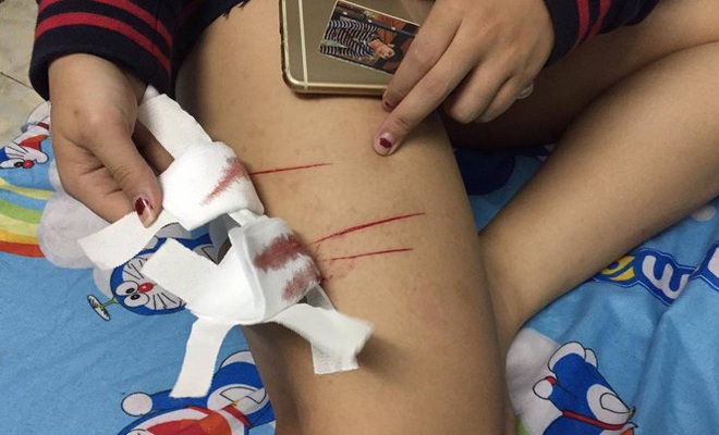 Nữ sinh ở TPHCM bị rạch đùi gây thương tích trên đường đi học về - Ảnh 1.