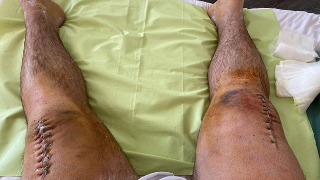 G&atilde;y cả 2 ch&acirc;n v&igrave; squat 400 kg, VĐV cử tạ đăng ảnh đầu gối chi ch&iacute;t những mũi kh&acirc;u - Ảnh 2.