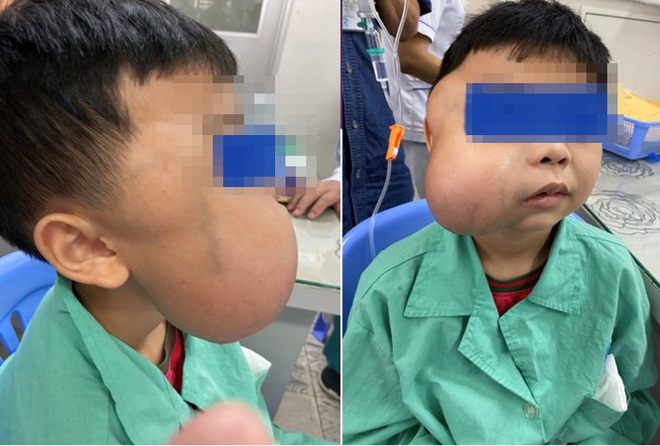 Khối u l&agrave;m biến dạng khu&ocirc;n mặt b&eacute; trai 13 tuổi lần đầu ph&aacute;t hiện ở Việt Nam - Ảnh 1.