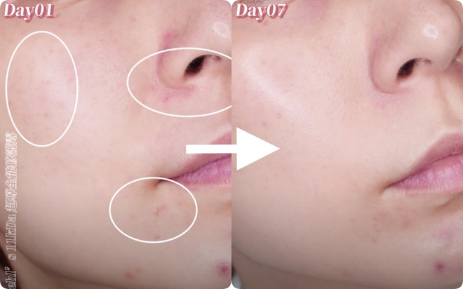Beauty blogger xứ Đài trực tiếp check khả năng trị nám, trẻ hóa da của serum Kiehls: Sau 7 ngày vết thâm to mờ dần, vết nhỏ lặn mất tăm - Ảnh 7.