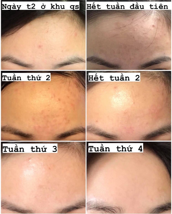 Nổi mụn ẩn sần khắp trán, nàng sinh viên vẫn trị khỏi thành công nhờ toàn đồ skincare giá rẻ - Ảnh 2.