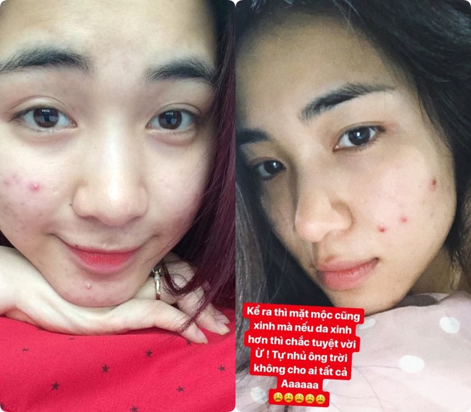 Không uống được nước diếp cá để trị mụn như Hòa Minzy, bạn hãy dùng 5 món skincare mang thành phần lợi hại này - Ảnh 2.