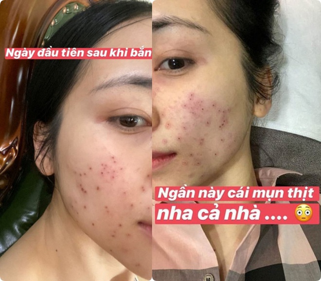 Không uống được nước diếp cá để trị mụn như Hòa Minzy, bạn hãy dùng 5 món skincare mang thành phần lợi hại này - Ảnh 3.