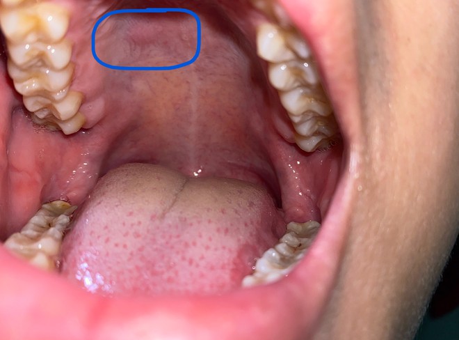 4 triệu chứng điển hình thường xuất hiện trong giai đoạn đầu của bệnh ung thư miệng, xem thử bạn có thuộc nhóm nào không - Ảnh 4.