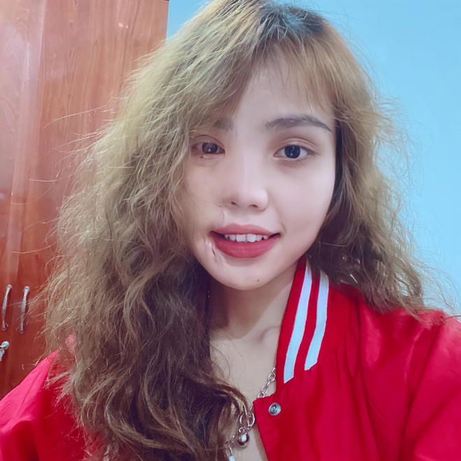 Cô gái bị chồng sắp cưới tạt axit hủy hoại nửa khuôn mặt và hành trình đau đớn để phục hồi nhan sắc ngoạn mục - Ảnh 4. Cô gái bị chồng sắp cưới tạt axit hủy hoại nửa khuôn mặt và hành trình đau đớn để phục hồi nhan sắc ngoạn mục - Ảnh 4.