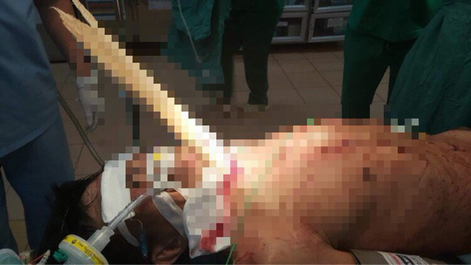 Cứu người đàn ông bị tai nạn hy hữu - thanh gỗ nửa mét đâm xuyên cổ - Ảnh 1.