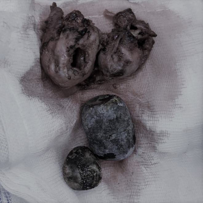 Đau bụng dữ dội, vào viện phát hiện sỏi túi mật hóa thạch bên trong - Ảnh 1.