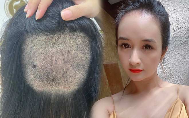 Người phụ nữ tốn gần 200 trăm triệu cấy tóc, netizen nhìn tác phẩm mà muốn lả đi - Ảnh 5.