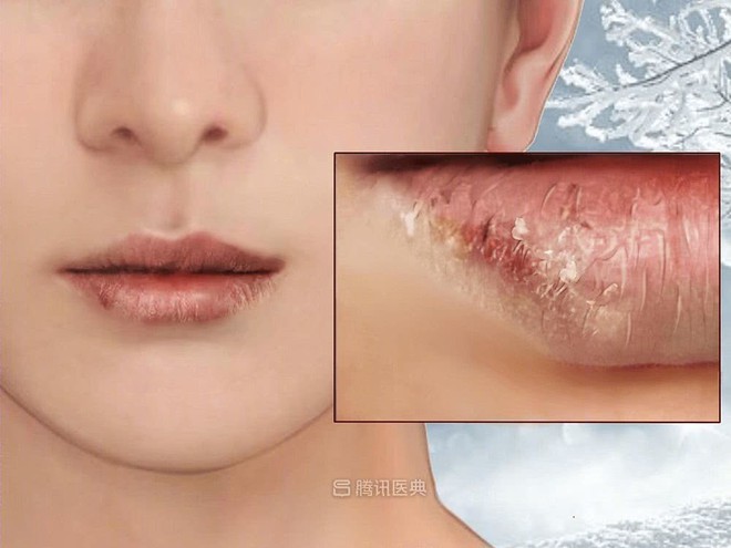 Môi có nứt nẻ, bong tróc mấy cũng đừng liếm, hãy làm 5 bước hiệu quả để sở hữu môi xinh đón xuân nhé - Ảnh 4. Môi có nứt nẻ, bong tróc mấy cũng đừng liếm, hãy làm 5 bước hiệu quả để sở hữu môi xinh đón xuân nhé - Ảnh 4.