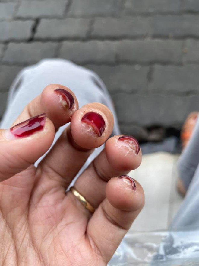 Trước Tết thi nhau khoe nail sang chảnh, ra Tết lại kể khổ vì móng nham nhở như chuột gặm: Ai làm nail cũng chịu trận cảnh này thôi! - Ảnh 6.