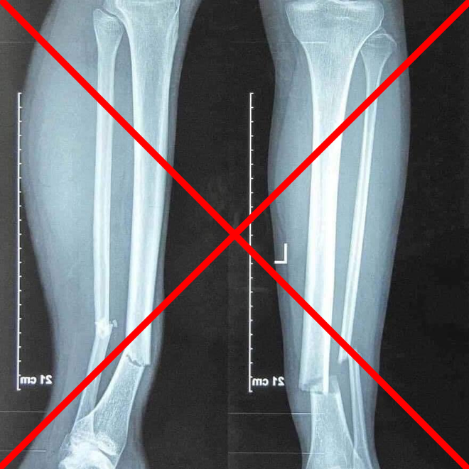 Thực hư ảnh chụp X-quang gãy rời 2 chân gây sốc của Hùng Dũng - Ảnh 1.