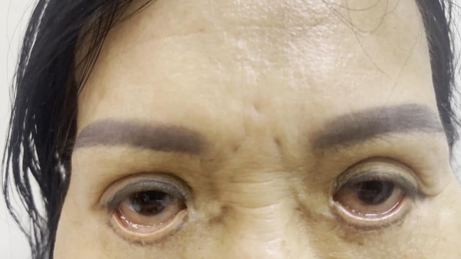 Mắt bị trợn ngược v&igrave; cắt m&iacute; tại spa - Ảnh 1.