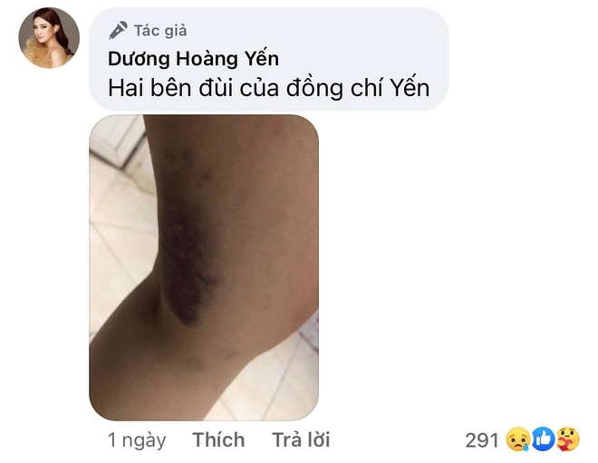 Dương Hoàng Yến chia sẻ hình ảnh đôi chân đầy hoa văn tím ngắt khi đi nhập ngũ khiến ai nấy đều xót xa - Ảnh 2.