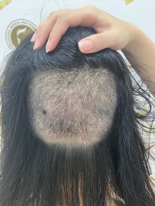 Chi 90 triệu để cấy tóc trị trán dô: Cô nàng này thú nhận từng bất an cực độ vì tóc rụng lả tả, sau nửa năm mới dám thở phào nhẹ nhõm - Ảnh 3.