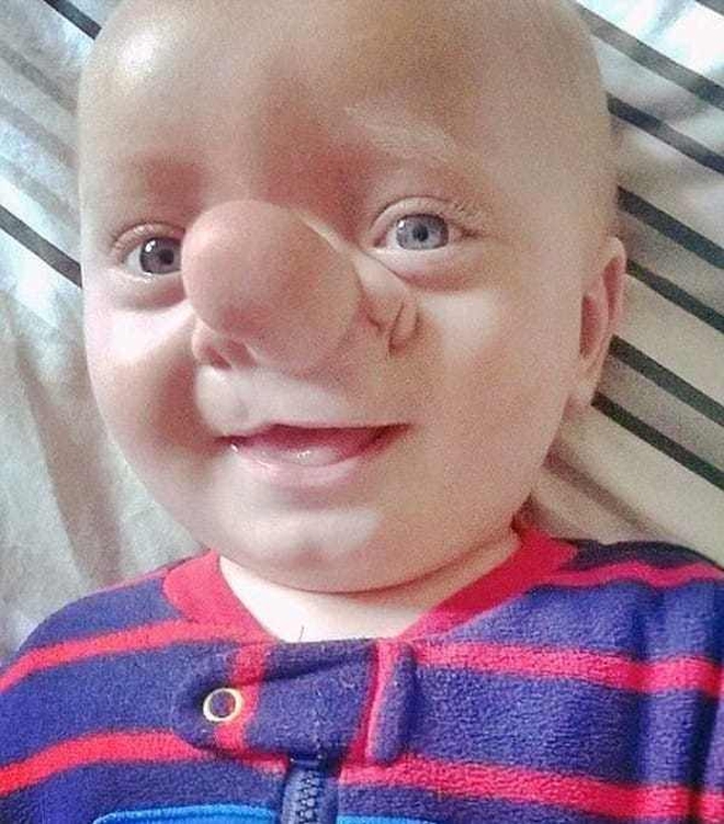 'Cậu bé Pinocchio đời thực” sinh ra với chiếc mũi to dị dạng khiến bố mẹ cũng sốc, gây bất ngờ với diện mạo sau ít năm 5 3 16176960348261592821171