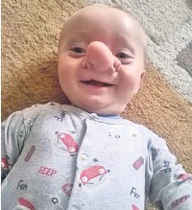 'Cậu bé Pinocchio đời thực” sinh ra với chiếc mũi to dị dạng khiến bố mẹ cũng sốc, gây bất ngờ với diện mạo sau ít năm 3 o 1617696404532758140044
