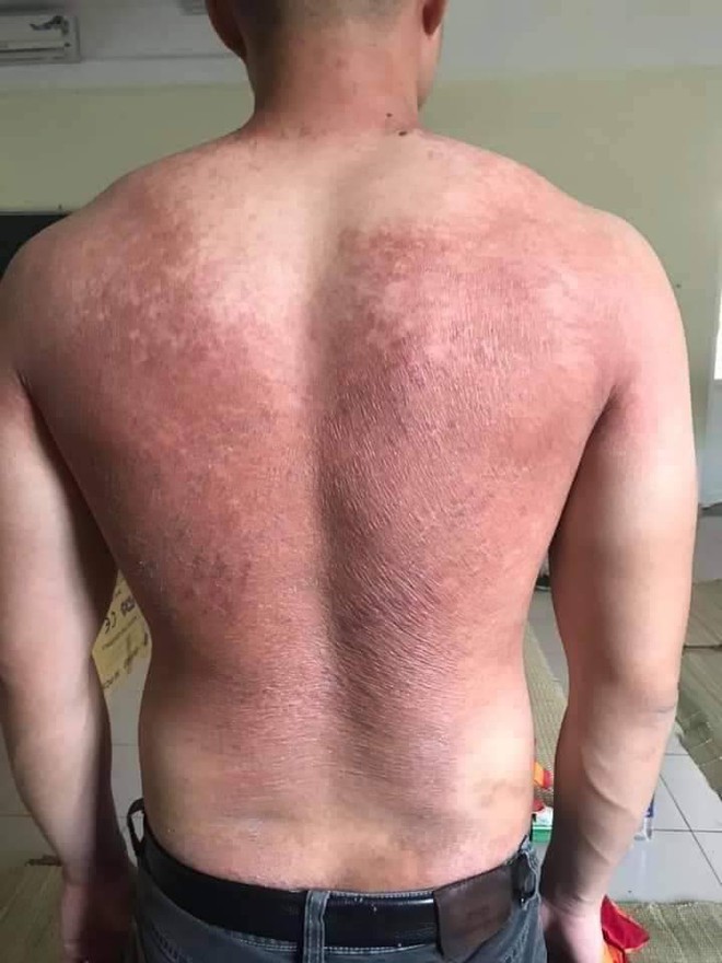 Hình ảnh bác sĩ nơi tâm dịch Bắc Giang khiến nhiều người xót xa: Phía sau lớp áo bảo hộ là tấm lưng cháy nắng phồng rộp - Ảnh 2. Hình ảnh bác sĩ nơi tâm dịch Bắc Giang khiến nhiều người xót xa: Phía sau lớp áo bảo hộ là tấm lưng cháy nắng phồng rộp - Ảnh 2.