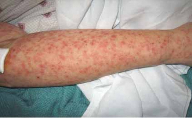 Dịch sốt virus Chikungunya bùng phát tại 13 tỉnh ở Campuchia - Ảnh 1.