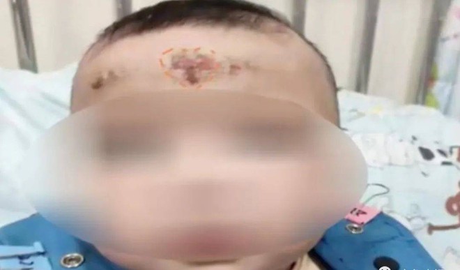 Bé gái 10 tháng tuổi xuất hiện dấu hiệu lạ trên trán, mẹ hốt hoảng đưa con đến bệnh viện rồi ngã ngửa vì cách chữa bệnh theo kiểu bà ngoại - Ảnh 2.