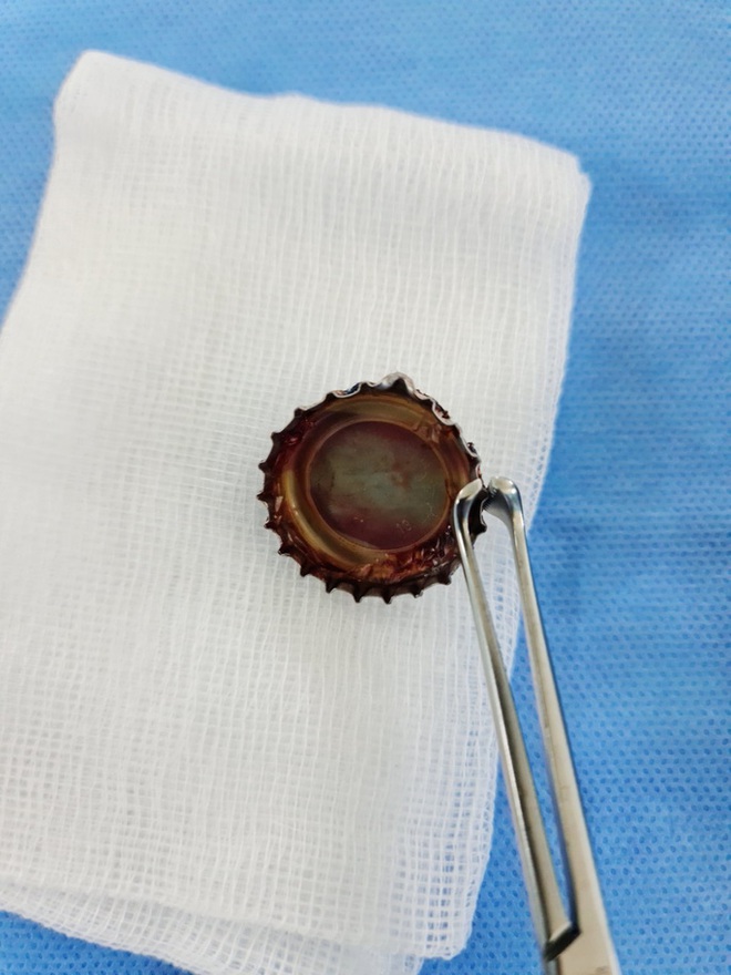 Nắp chai kim loại cắm v&agrave;o thực quản thanh ni&ecirc;n hơn 2 th&aacute;ng - Ảnh 2.